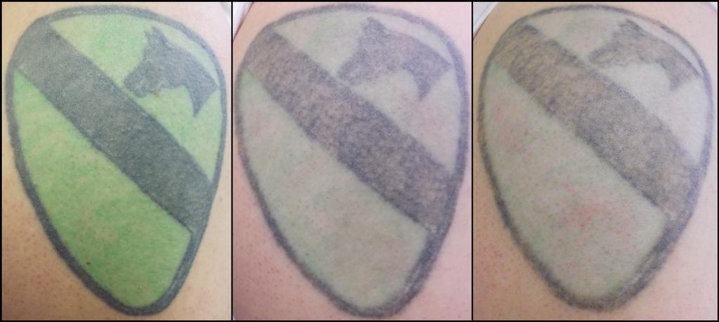 Pictures for Vanish Laser Tattoo Removal and Skin ...